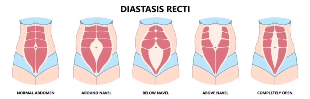 Illustration showing different stages of diastasis recti in the abdomen.