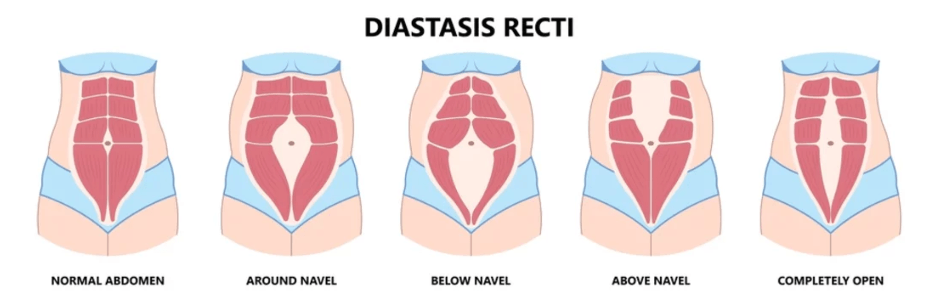 Diastasis Recti (Abdominal Separation)