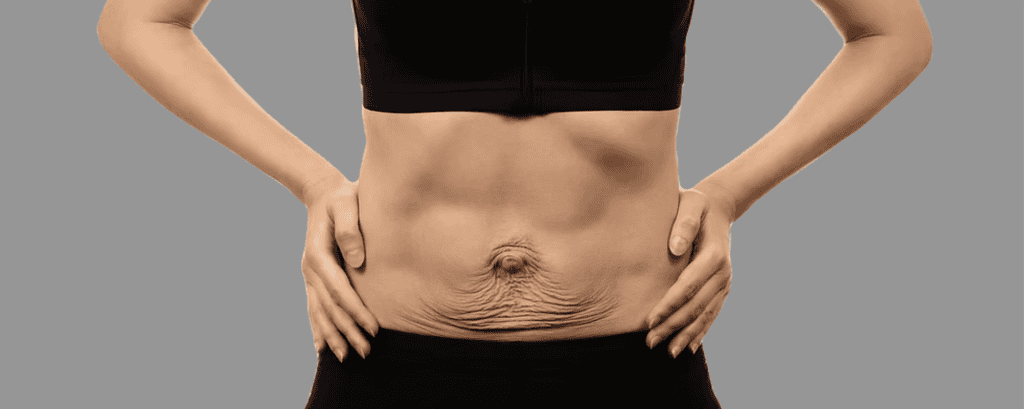 A woman’s abdominal area showing skin and muscle after recovery from separation.