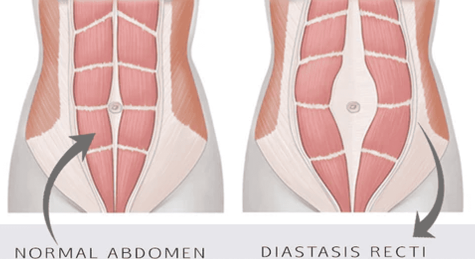 A woman’s abdominal muscles showing normal and diastasis recti conditions.