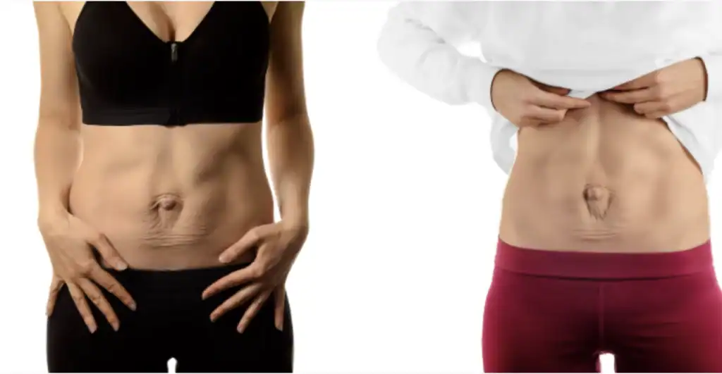 Physio for Abdominal Separation