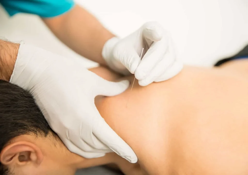 Dry needling Sydney
