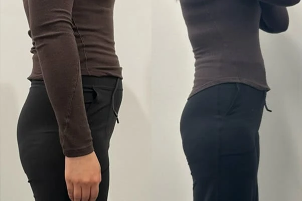 Pelvic floor physiotherapy